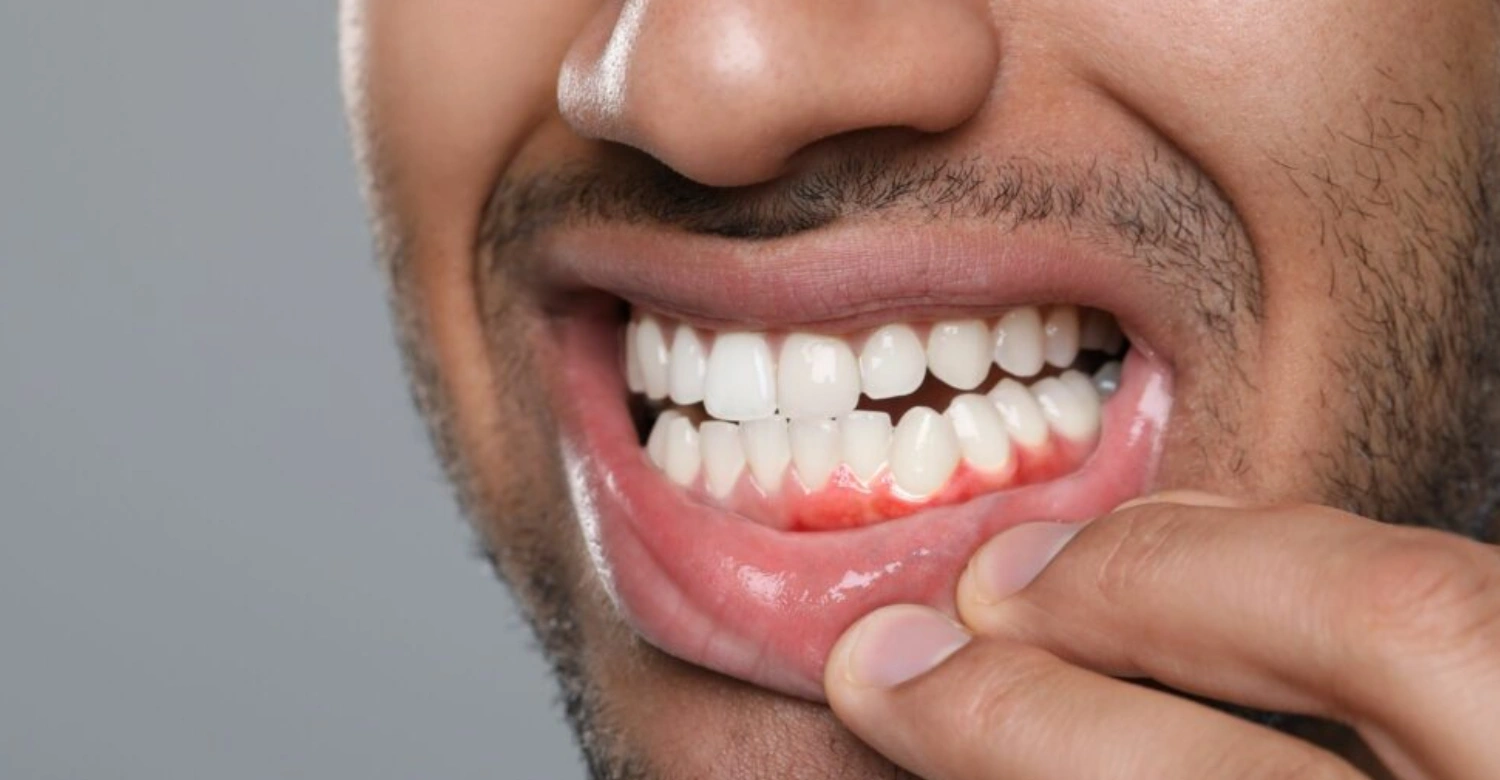 Sensitive Gums Treatment How to Protect and Heal Your Gums Inblog